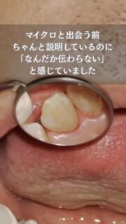 マイクロスコープと出会う前、OHIやSRPの説明をしても「本当に伝わっているのかな？」と感じることがありました。

でも、マイクロスコープで実際にご自身のプラークや歯石を映像で見ていただくと、患者さんの反応は全く違います。

「こんなについてるんですね！」「これは取らないとですね」

そんな言葉が自然と出てくるようになりました。

伝えるだけではなく、“見て理解してもらえる”こと。

マイクロスコープは歯科衛生士のOＨIやSRPの説明を助けてくれる存在です✨

#マイクロスコープ歯科衛生士 
#歯科衛生士マイクロスコープ
#歯科衛生士出張セミナー 
#歯科衛生士をみんなで盛り上げよう 
#mdh歯科衛生士